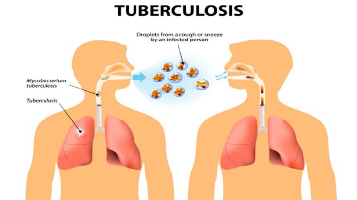 Tuberculosis, Main Causes of Tuberculosis,, What Causes Tuberculosis, Tuberculosis Causes, Causes of Tuberculosis