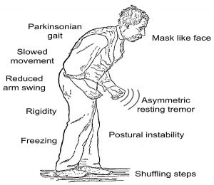 Parkinson's disease: signs and symptoms