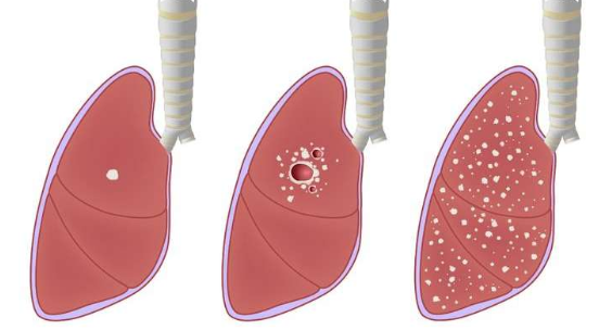 Tuberculosis: Causes Symptoms Risks and Preventions